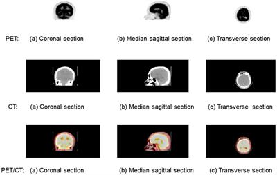 Frontal Cortex Segmentation of Brain PET Imaging Using Deep Neural Networks